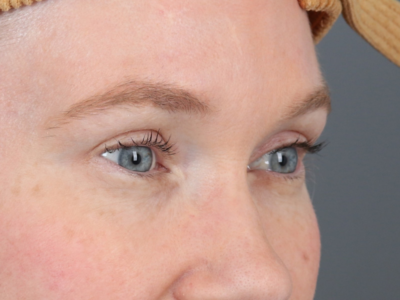 Brow Lift Before and After | Dr. Michael Kim