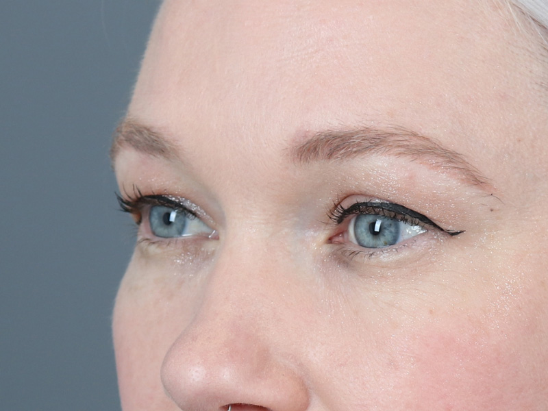 Brow Lift Before and After | Dr. Michael Kim