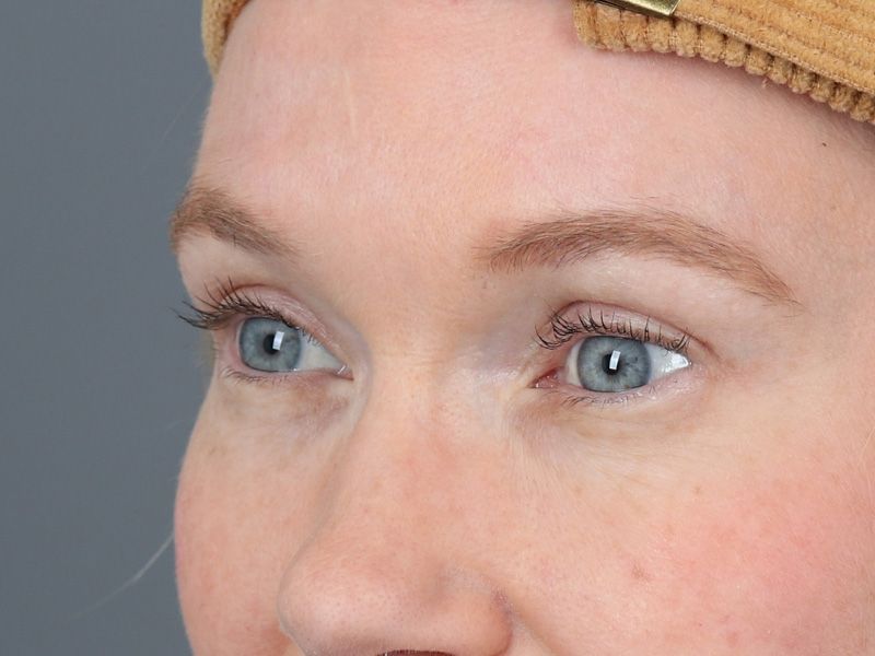 Brow Lift Before and After | Dr. Michael Kim