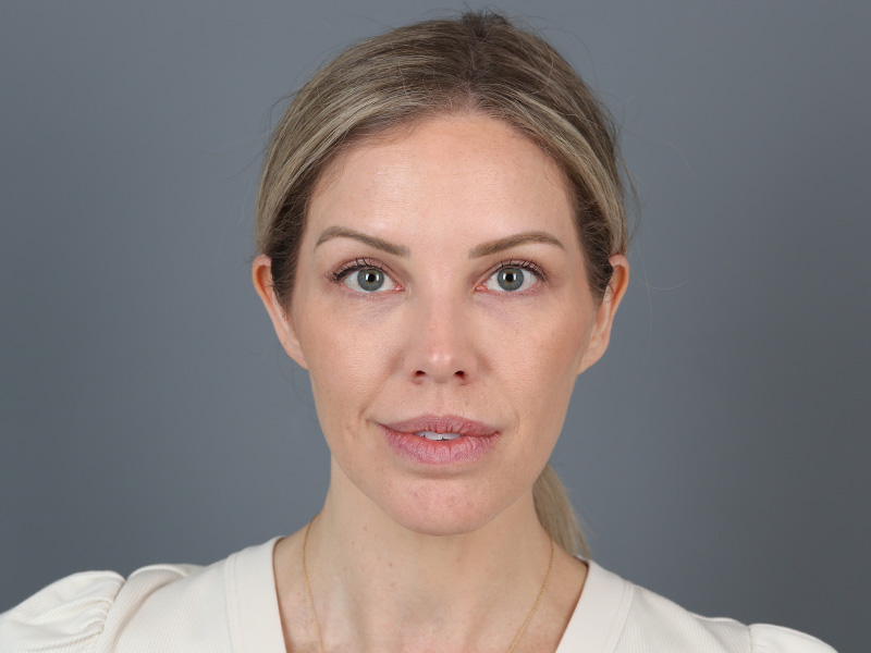 Brow Lift Before and After | Dr. Michael Kim