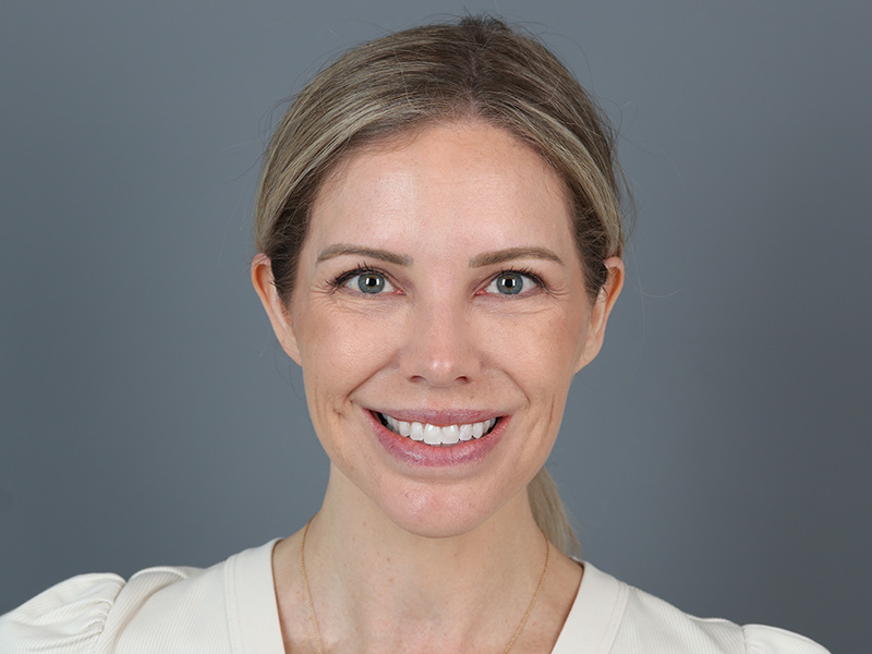 Brow Lift Before and After | Dr. Michael Kim
