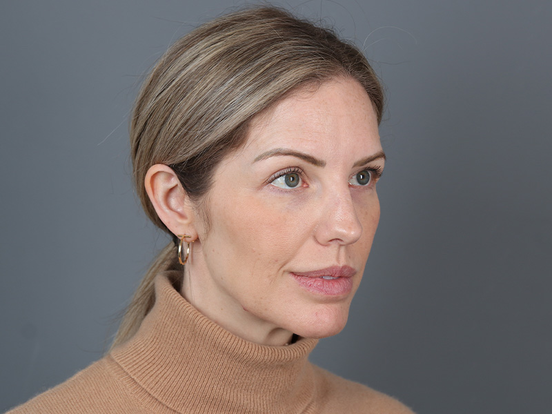 Brow Lift Before and After | Dr. Michael Kim