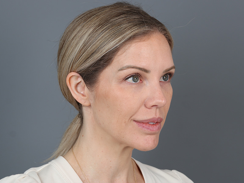 Brow Lift Before and After | Dr. Michael Kim