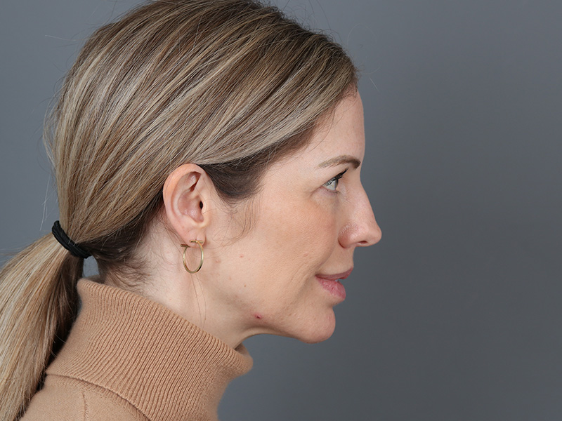 Brow Lift Before and After | Dr. Michael Kim