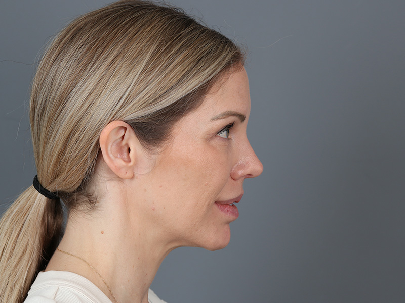 Brow Lift Before and After | Dr. Michael Kim