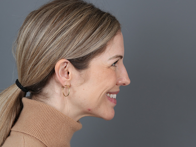 Brow Lift Before and After | Dr. Michael Kim