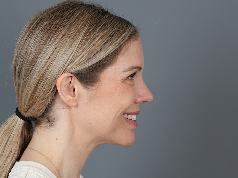 Brow Lift Before and After | Dr. Michael Kim