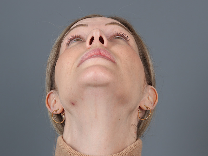 Brow Lift Before and After | Dr. Michael Kim