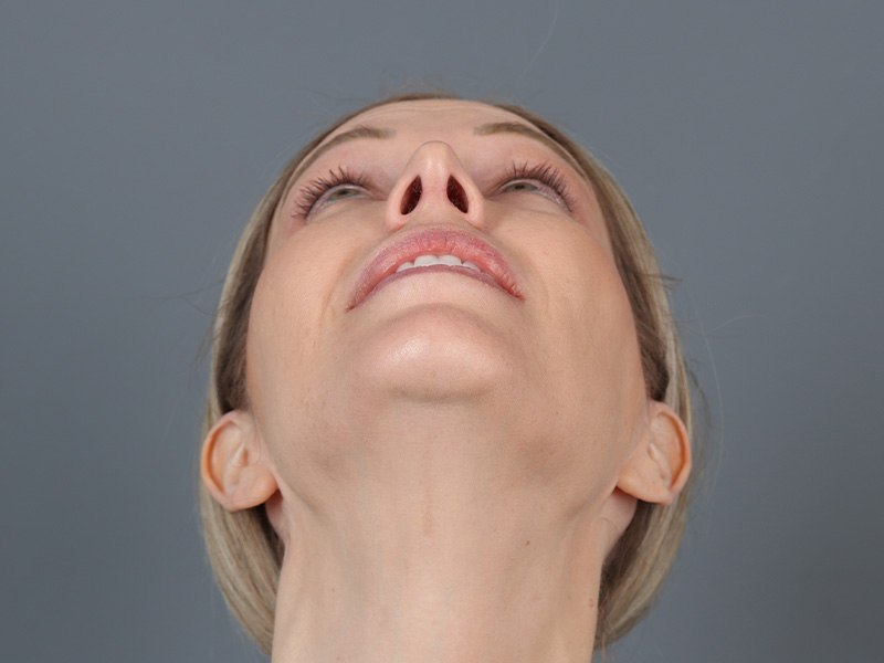 Brow Lift Before and After | Dr. Michael Kim