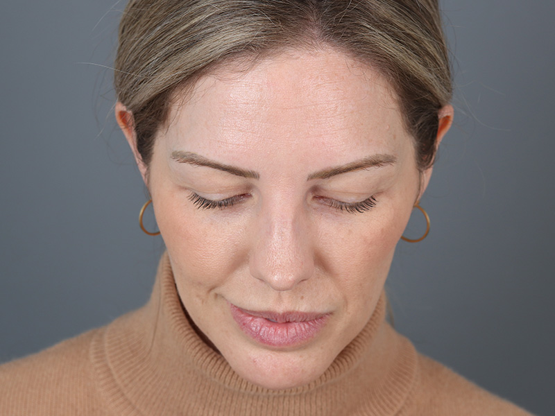 Brow Lift Before and After | Dr. Michael Kim