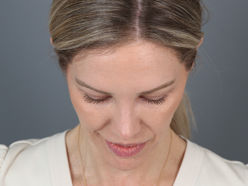 Brow Lift Before and After | Dr. Michael Kim