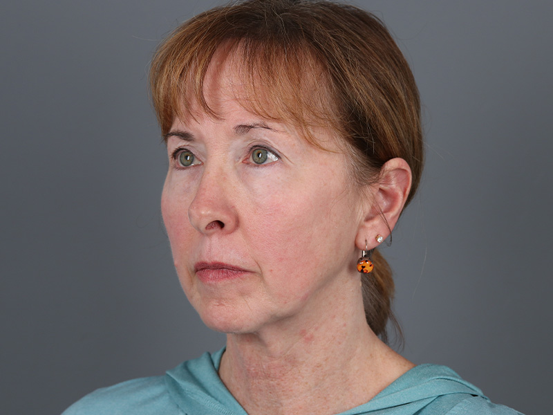 Brow Lift Before and After | Dr. Michael Kim