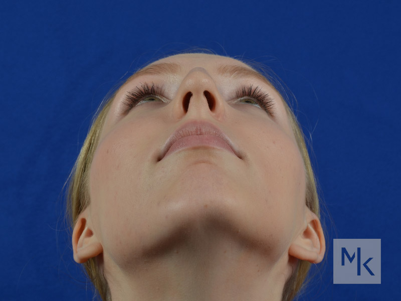 Chin Filler Before and After | Dr. Michael Kim