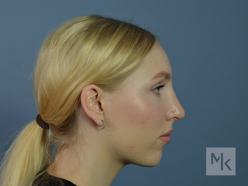 Chin Filler Before and After | Dr. Michael Kim