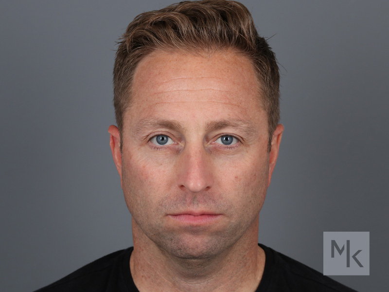 Chin Augmentation in Portland