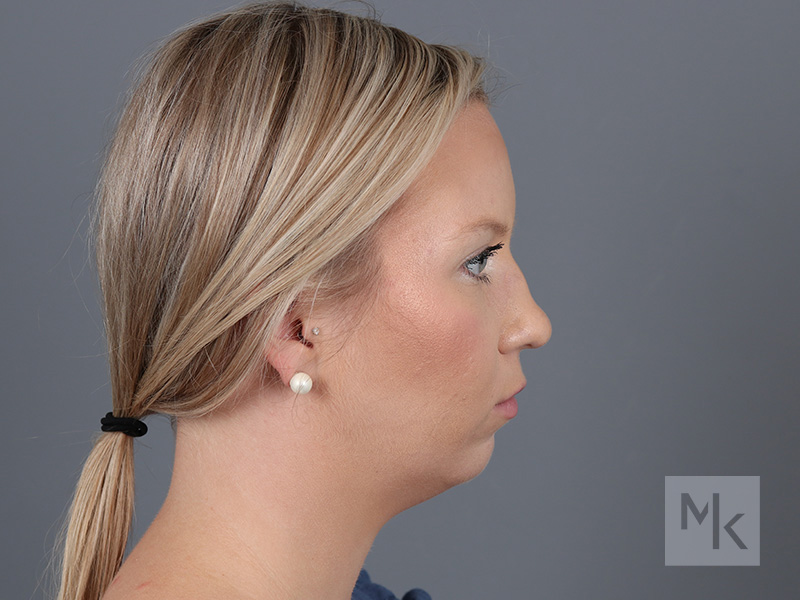 Chin Implant Before and After | Dr. Michael Kim