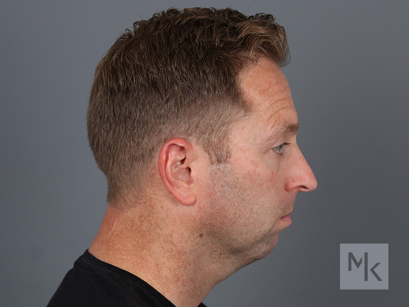 Chin Implant Before and After | Dr. Michael Kim