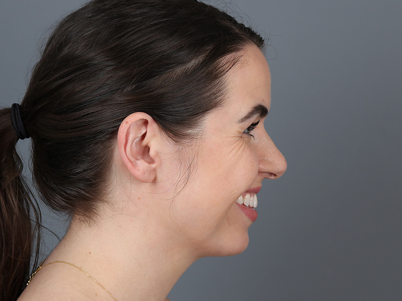 Chin Implant Before and After | Dr. Michael Kim