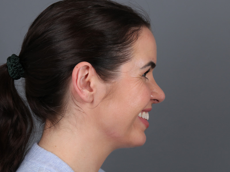 Chin Implant Before and After | Dr. Michael Kim