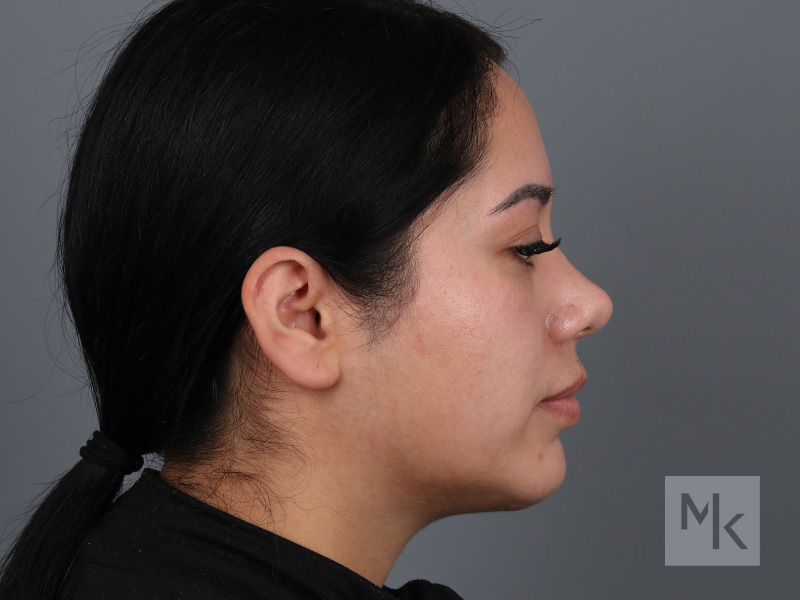 Chin Implant Before and After | Dr. Michael Kim