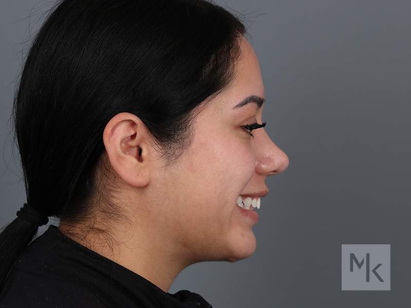 Chin Implant Before and After | Dr. Michael Kim