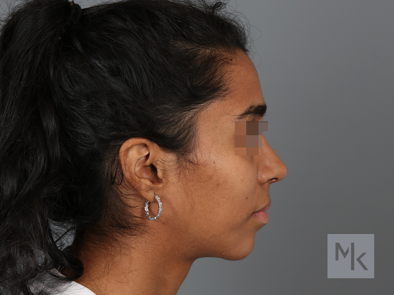 Chin Implant Before and After | Dr. Michael Kim