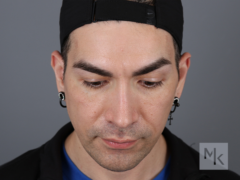 Chin Implant Before and After | Dr. Michael Kim