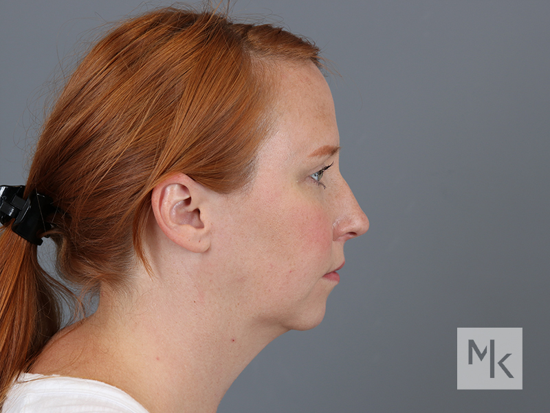 Chin Implant Before and After | Dr. Michael Kim