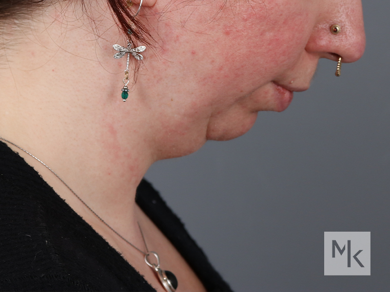 Chin Implant Before and After | Dr. Michael Kim