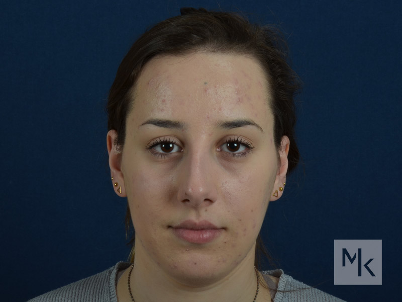 Chin Implant Before and After | Dr. Michael Kim