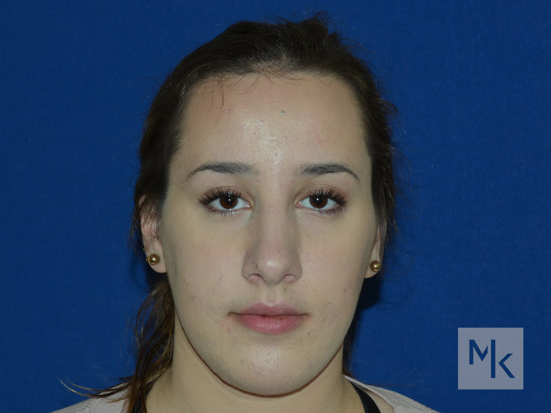 Chin Implant Before and After | Dr. Michael Kim