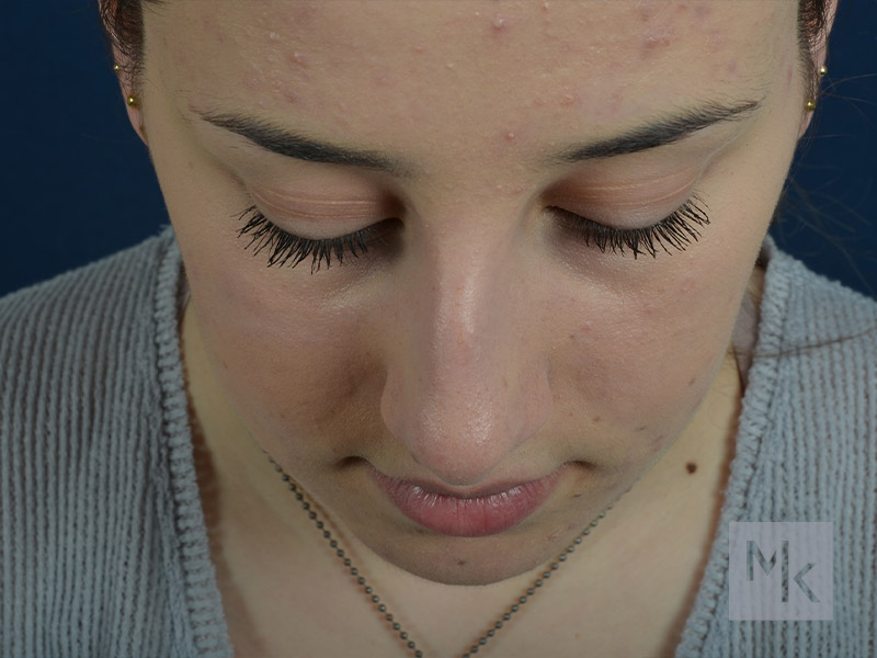 Chin Implant Before and After | Dr. Michael Kim