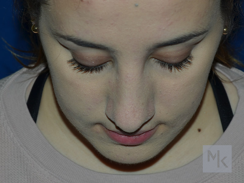Chin Implant Before and After | Dr. Michael Kim