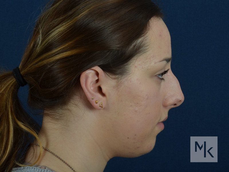 Chin Implant Before and After | Dr. Michael Kim
