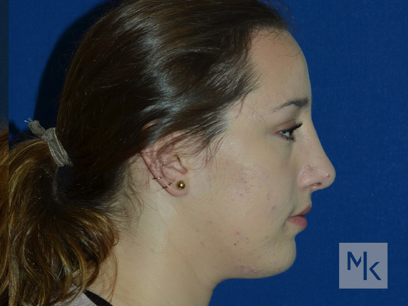 Chin Implant Before and After | Dr. Michael Kim