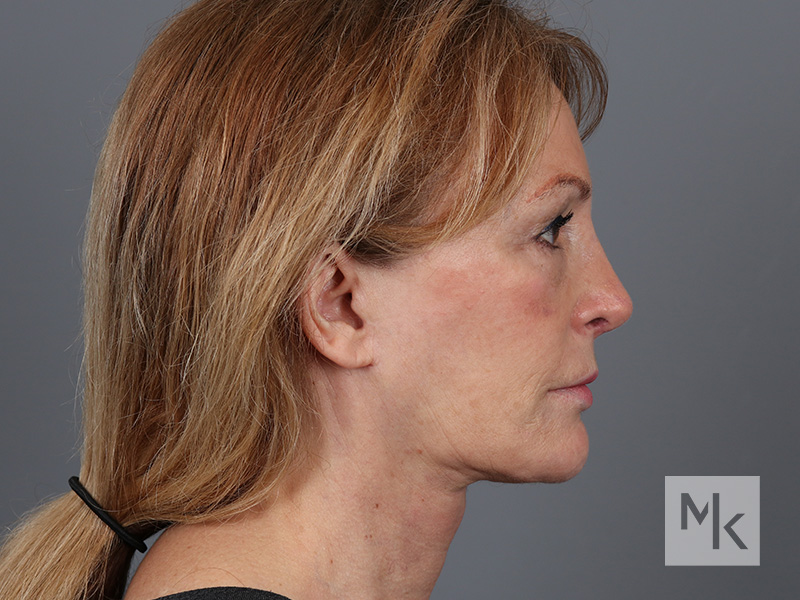 Facelift Before and After | Dr. Michael Kim