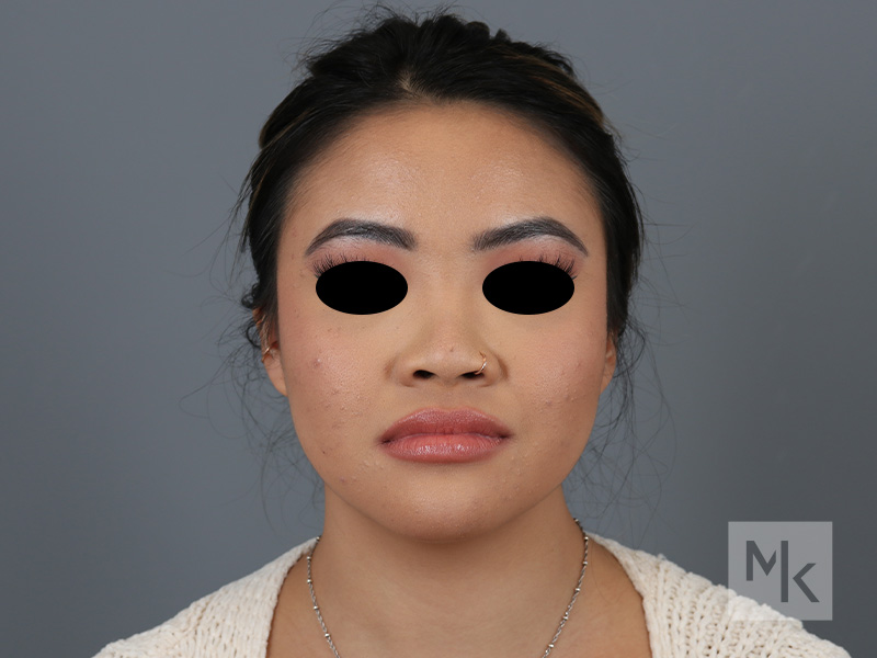 Ethnic Rhinoplasty Before and After | Dr. Michael Kim