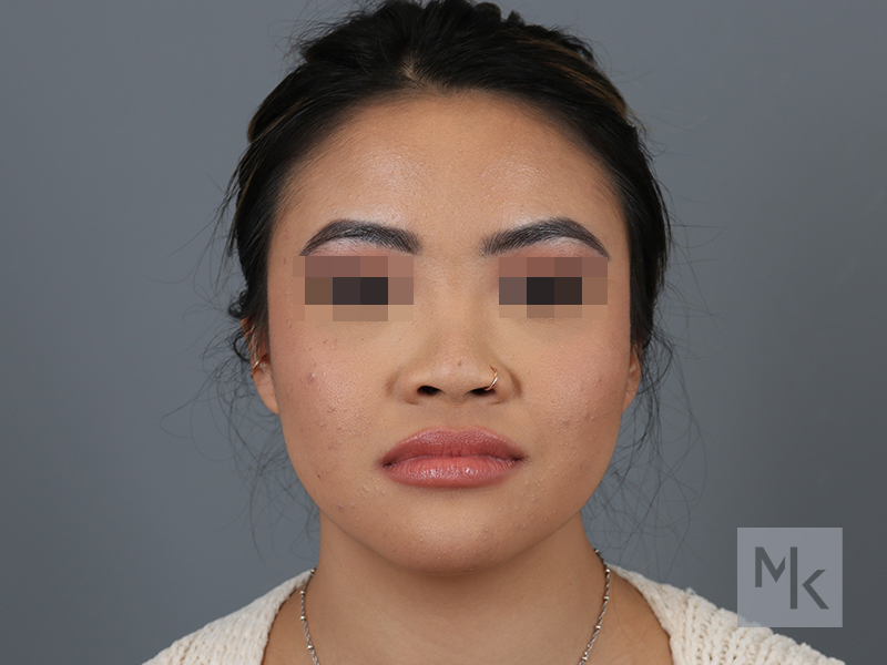 Ethnic Rhinoplasty in Portland