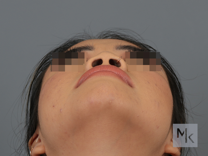 Ethnic Rhinoplasty Before and After | Dr. Michael Kim