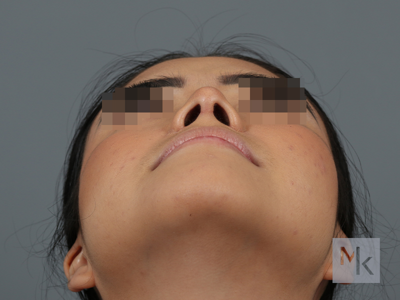 Ethnic Rhinoplasty Before and After | Dr. Michael Kim