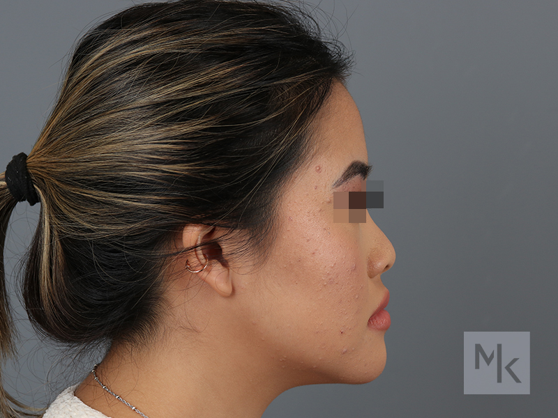 Ethnic Rhinoplasty Before and After | Dr. Michael Kim