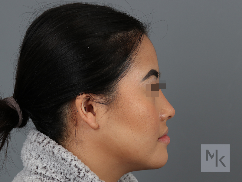 Ethnic Rhinoplasty Before and After | Dr. Michael Kim