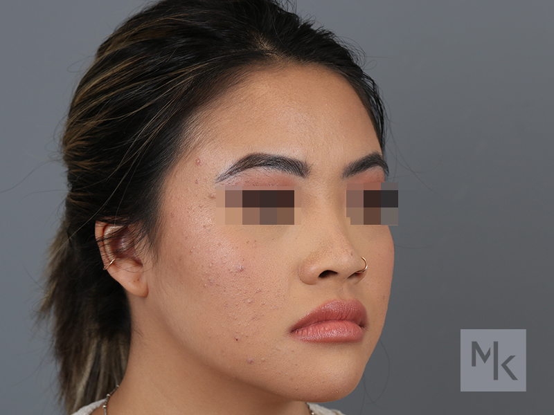 Ethnic Rhinoplasty Before and After | Dr. Michael Kim