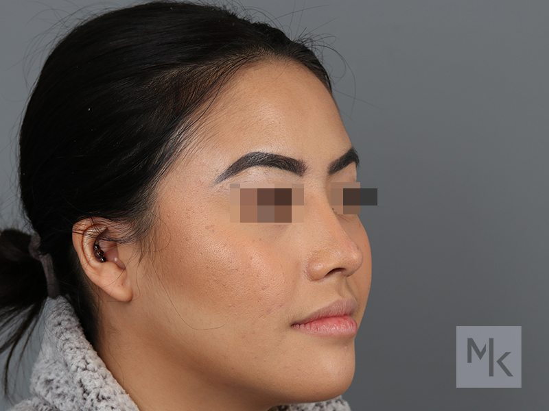 Ethnic Rhinoplasty Before and After | Dr. Michael Kim