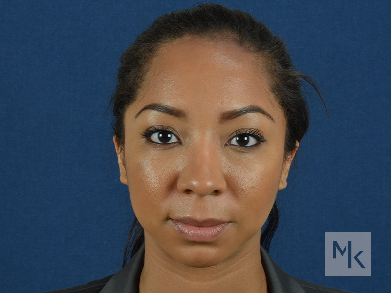 Ethnic Rhinoplasty Before and After | Dr. Michael Kim