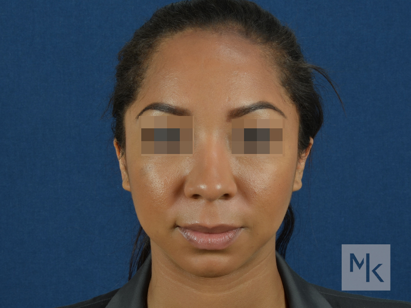 Ethnic Rhinoplasty Before and After | Dr. Michael Kim