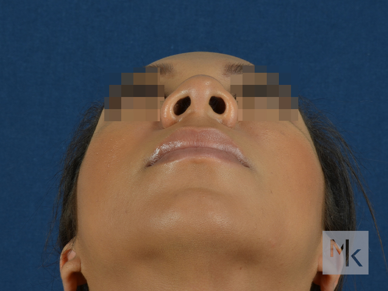 Ethnic Rhinoplasty Before and After | Dr. Michael Kim