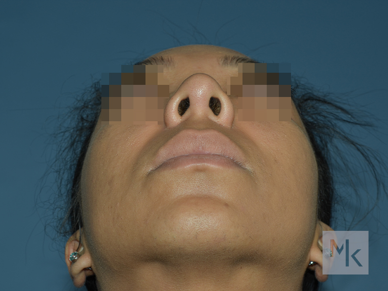 Ethnic Rhinoplasty Before and After | Dr. Michael Kim