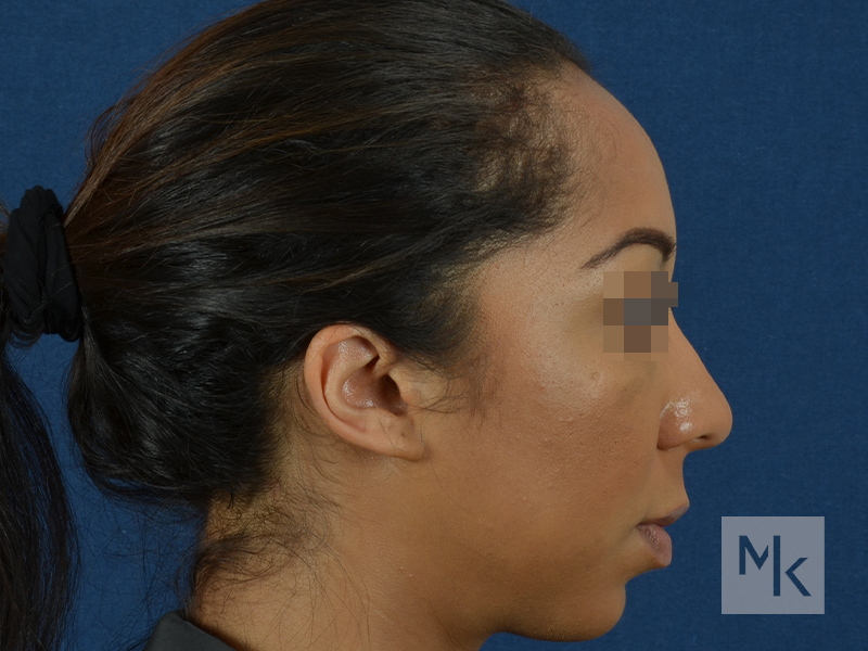 Ethnic Rhinoplasty Before and After | Dr. Michael Kim