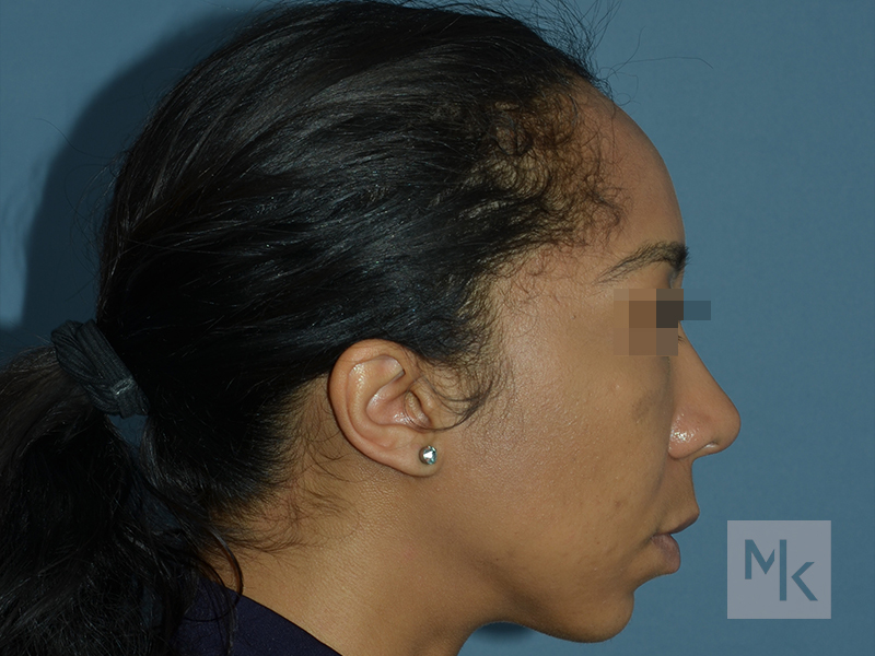 Ethnic Rhinoplasty Before and After | Dr. Michael Kim